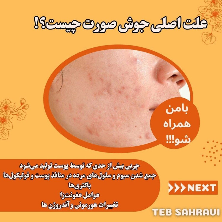 رفع جوش و جای جوش