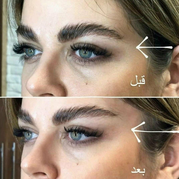 کش لیفیت شقیقه کش لیفت صورت