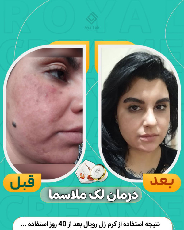 کرم ضدلک ژل رویال اصل